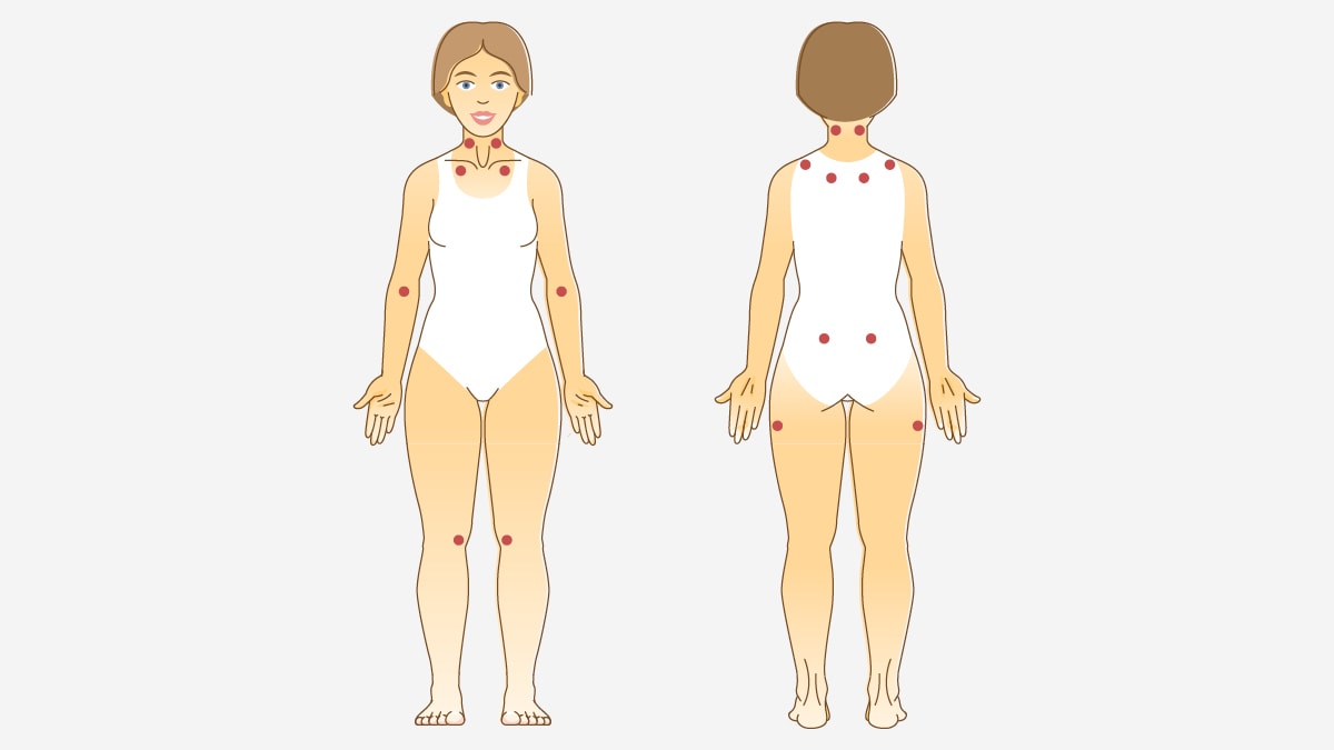 230403 Wdg Fibromyalgie 10