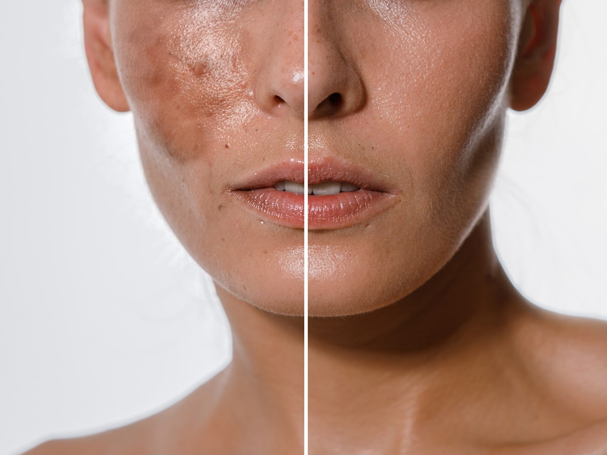 230403 Wdg Pigmentflecken 1