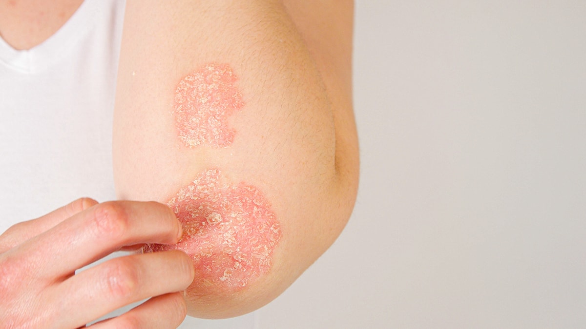 230403 Wdg Psoriasis 4
