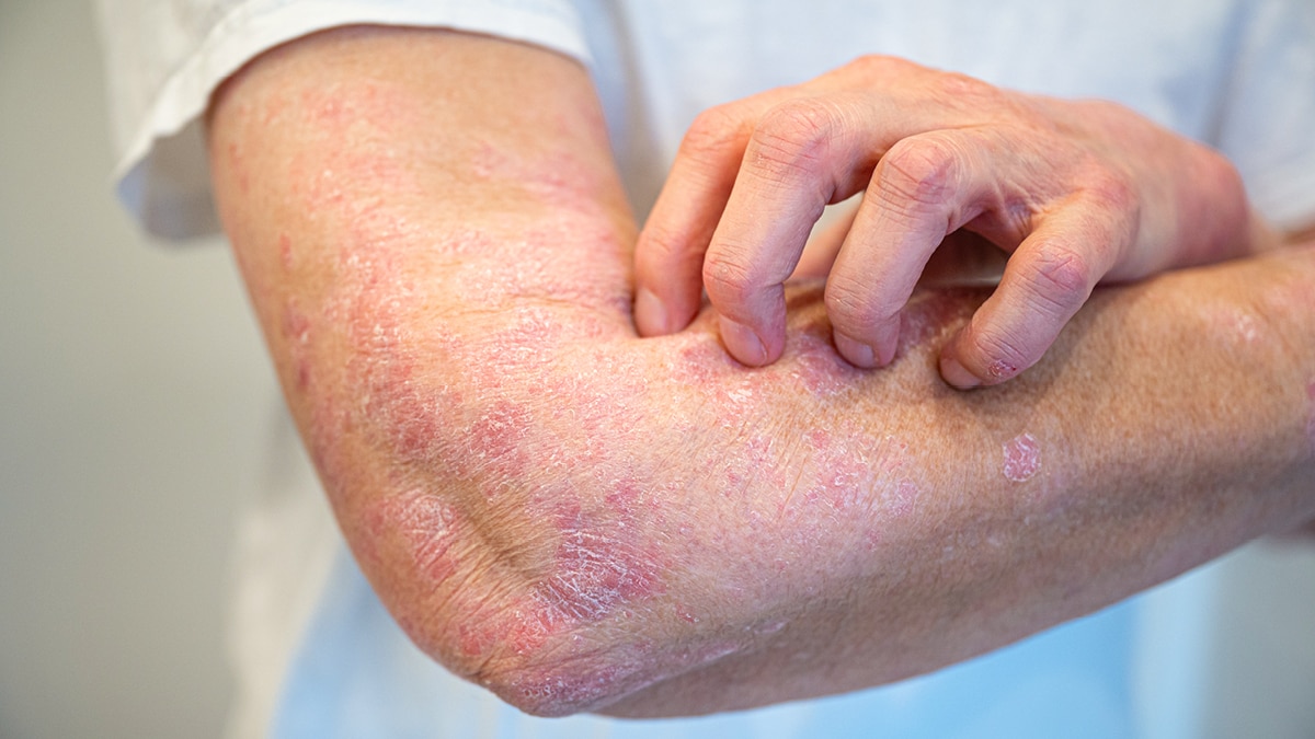 230403 Wdg Psoriasis 7